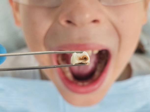 Best Emergency Root Canal Treatment in Johnsonburg, PA